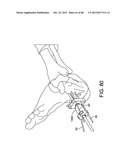 ORTHOPEDIC SURGICAL GUIDE diagram and image