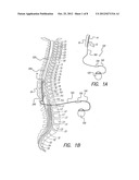 INSERTION TOOL FOR PADDLE-STYLE ELECTRODE diagram and image