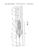 SLIDEABLE VASCULAR FILTER diagram and image