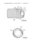 EXPANDABLE IMPLANT DEVICES FOR FILTERING BLOOD FLOW FROM ATRIAL APPENDAGES diagram and image