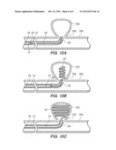 MEDICAL IMPLANT DETACHMENT SYSTEMS AND METHODS diagram and image