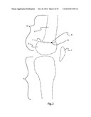 BONE ALIGNMENT IMPLANT AND METHOD OF USE diagram and image