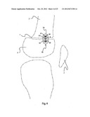 BONE ALIGNMENT IMPLANT AND METHOD OF USE diagram and image