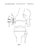 BONE ALIGNMENT IMPLANT AND METHOD OF USE diagram and image