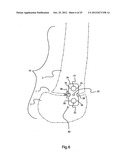 BONE ALIGNMENT IMPLANT AND METHOD OF USE diagram and image