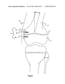 BONE ALIGNMENT IMPLANT AND METHOD OF USE diagram and image