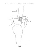 BONE ALIGNMENT IMPLANT AND METHOD OF USE diagram and image