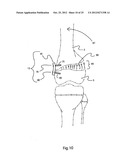 BONE ALIGNMENT IMPLANT AND METHOD OF USE diagram and image