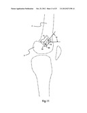 BONE ALIGNMENT IMPLANT AND METHOD OF USE diagram and image