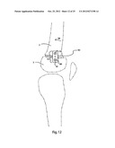 BONE ALIGNMENT IMPLANT AND METHOD OF USE diagram and image