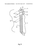 BONE ALIGNMENT IMPLANT AND METHOD OF USE diagram and image