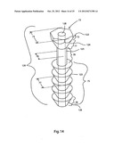 BONE ALIGNMENT IMPLANT AND METHOD OF USE diagram and image