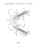 BONE ALIGNMENT IMPLANT AND METHOD OF USE diagram and image