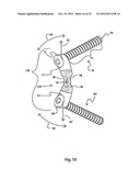 BONE ALIGNMENT IMPLANT AND METHOD OF USE diagram and image