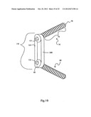 BONE ALIGNMENT IMPLANT AND METHOD OF USE diagram and image