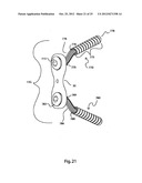 BONE ALIGNMENT IMPLANT AND METHOD OF USE diagram and image