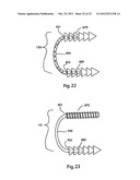 BONE ALIGNMENT IMPLANT AND METHOD OF USE diagram and image