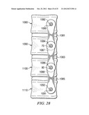 BONE ALIGNMENT IMPLANT AND METHOD OF USE diagram and image