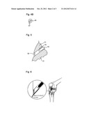 PLUG COMPONENTS FOR BONE TUNNEL diagram and image