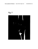 PLUG COMPONENTS FOR BONE TUNNEL diagram and image