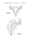 FALLOPIAN TUBE OCCLUSION DEVICE diagram and image