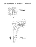 FALLOPIAN TUBE OCCLUSION DEVICE diagram and image