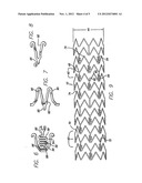 HYBRID STENT AND METHOD OF MAKING diagram and image