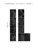 METHODS AND COMPOSITIONS FOR TREATING CONDITIONS ASSOCIATED WITH     ANGIOGENESIS USING A VASCULAR ADHESION PROTEIN-1 (VAP-1) INHIBITOR diagram and image