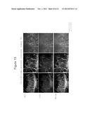 METHODS AND COMPOSITIONS FOR TREATING CONDITIONS ASSOCIATED WITH     ANGIOGENESIS USING A VASCULAR ADHESION PROTEIN-1 (VAP-1) INHIBITOR diagram and image