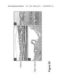 METHODS AND COMPOSITIONS FOR TREATING CONDITIONS ASSOCIATED WITH     ANGIOGENESIS USING A VASCULAR ADHESION PROTEIN-1 (VAP-1) INHIBITOR diagram and image