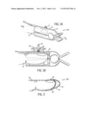 MEDICAL SENSOR FOR REDUCING MOTION ARTIFACTS AND TECHNIQUE FOR USING THE     SAME diagram and image