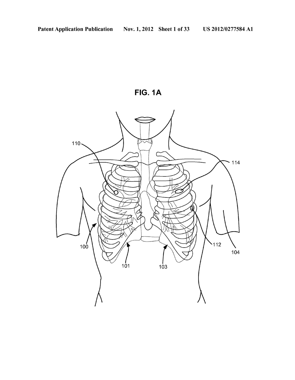 TWO-PHASE SURGICAL PROCEDURE FOR CREATING A PNEUMOSTOMA TO TREAT CHRONIC     OBSTRUCTIVE PULMONARY DISEASE - diagram, schematic, and image 02