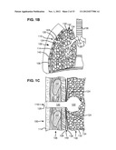 TWO-PHASE SURGICAL PROCEDURE FOR CREATING A PNEUMOSTOMA TO TREAT CHRONIC     OBSTRUCTIVE PULMONARY DISEASE diagram and image