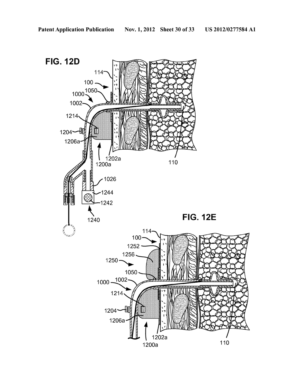 TWO-PHASE SURGICAL PROCEDURE FOR CREATING A PNEUMOSTOMA TO TREAT CHRONIC     OBSTRUCTIVE PULMONARY DISEASE - diagram, schematic, and image 31