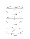 Shape and Pressure Adjustable Dressing diagram and image