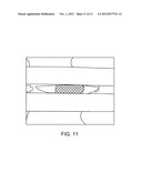 TISSUE ABLATION WITH IRREVERSIBLE ELECTROPORATION diagram and image