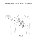 PACING IN THE PRESENCE OF ELECTROMAGENTIC INTERFERENCE diagram and image