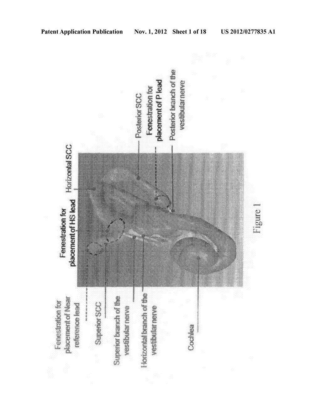 IMPLANTABLE VESTIBULAR PROSTHESIS - diagram, schematic, and image 02