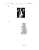 METHODS OF SCREENING FOR COMPOUNDS FOR USE AS MODULATORS OF LEFT-RIGHT     ASYMMETRY IN SCOLIOTIC SUBJECTS AND FOR MONITORING EFFICACY OF AN     ORTHOPAEDIC DEVICE diagram and image