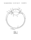 Methods and Apparatuses for the Treatment of Glaucoma using visible and     infrared ultrashort laser pulses diagram and image