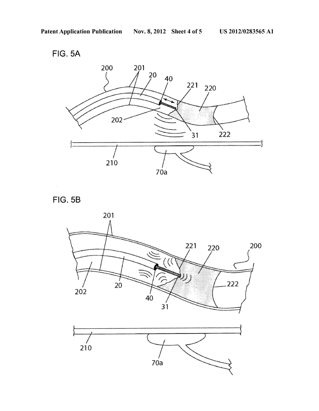 APPARATUS AND METHOD FOR GUIDED CHRONIC TOTAL OCCLUSION PENETRATION - diagram, schematic, and image 05