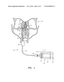 METHOD FOR TREATMENT OF ETHMOIDS diagram and image