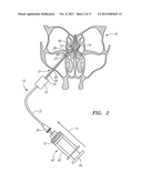 METHOD FOR TREATMENT OF ETHMOIDS diagram and image