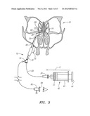 METHOD FOR TREATMENT OF ETHMOIDS diagram and image