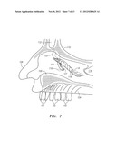 METHOD FOR TREATMENT OF ETHMOIDS diagram and image