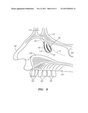 METHOD FOR TREATMENT OF ETHMOIDS diagram and image