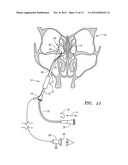 METHOD FOR TREATMENT OF ETHMOIDS diagram and image