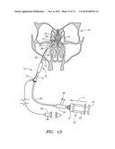 METHOD FOR TREATMENT OF ETHMOIDS diagram and image