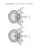 SUTURE PASSER DEVICES AND METHODS diagram and image