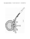 SUTURE PASSER DEVICES AND METHODS diagram and image